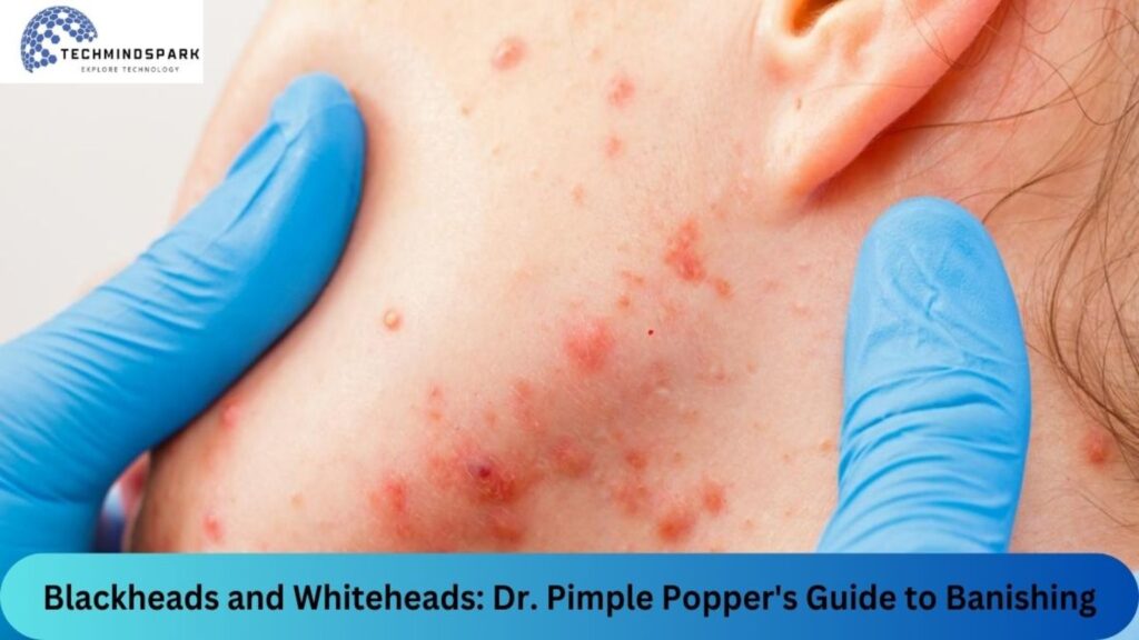 Blackheads and Whiteheads